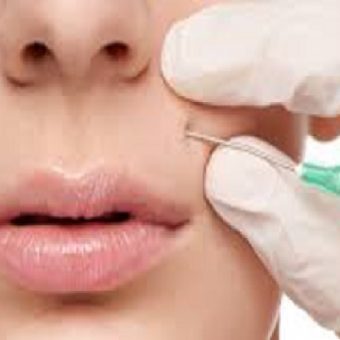 Изображение к статье по коррекции ботоксом морщин вокруг рта